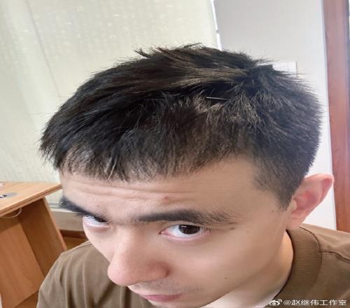 工作室晒赵继伟头&喉咙针灸图片:嗓子治疗进入下一阶段加油