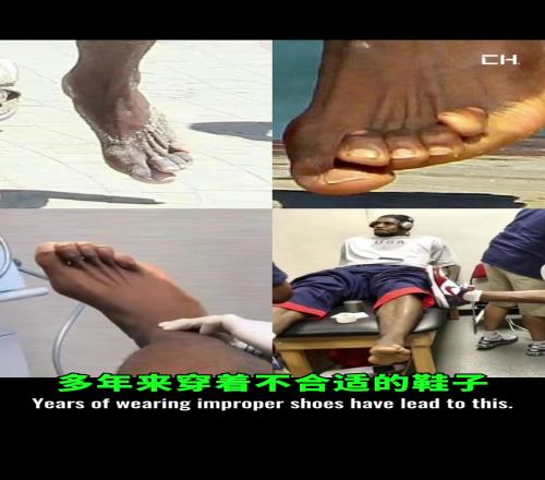 脚趾变形看着难受！看看詹姆斯在使用的脚趾分离器