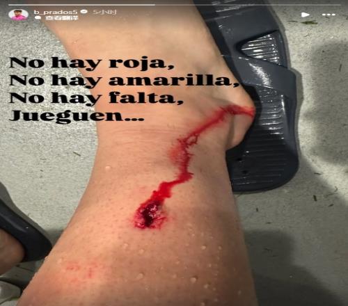 被林德洛夫出球后踢到小腿，毕尔巴鄂中场晒伤口：没红黄牌没犯规
