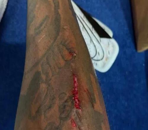 慎入，里斯詹姆斯的小腿在比赛里被划出一道血口子